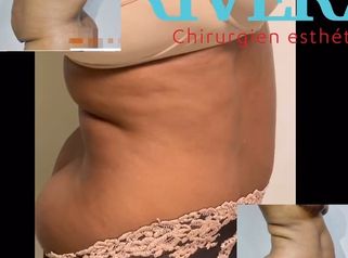 Abdominoplastie - Dr Juan Carlos Rivera