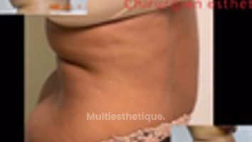 Abdominoplastie - Dr Juan Carlos Rivera