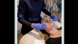 peeling avant / après 