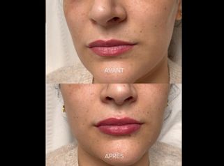 Augmentation des lèvres - Dr Alexandre Mertens