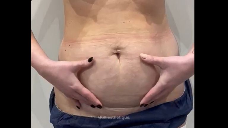 Liposuccion - Dr Laurent Benadiba