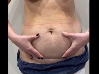Liposuccion - Dr Laurent Benadiba