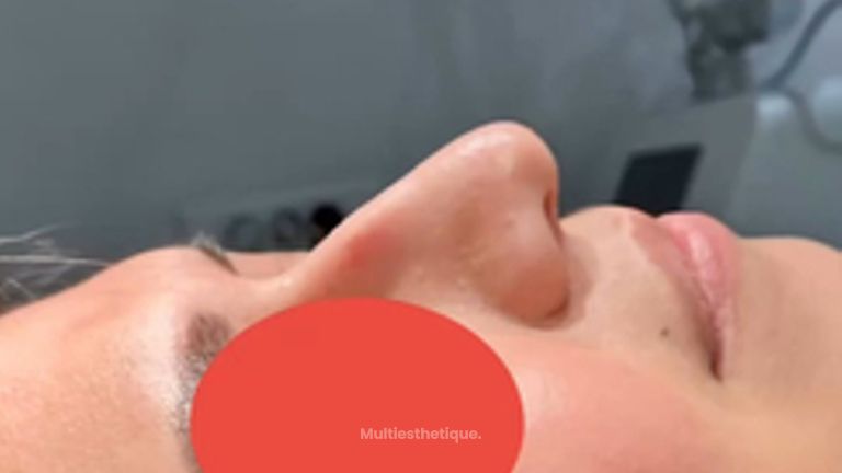Rhinoplastie médicale - Dr Rivera