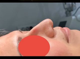 Rhinoplastie médicale - Dr Rivera