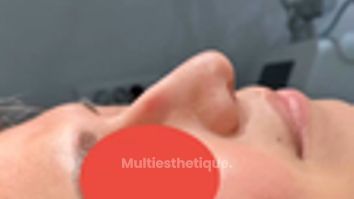 Rhinoplastie médicale - Dr Rivera