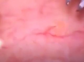 Laser spider veins removal : séance d’élimination des varices au laser sur une partie du corps