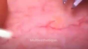 Laser spider veins removal : séance d’élimination des varices au laser sur une partie du corps