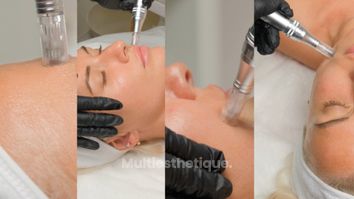 microneedling mesolfit - Centre Laser Murano - Épilation & Médecine Esthétique