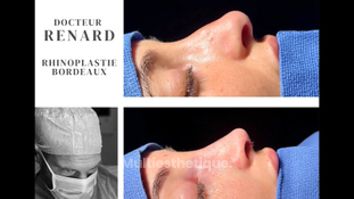 Rhinoplastie - Dr Pierre-Manuel Renard