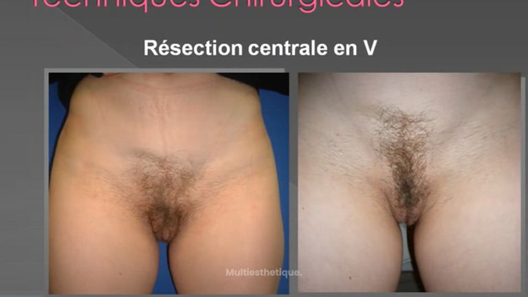 Nymphoplastie ou Labiaplastie: réduction des petites lèvres- labia minora_reduction