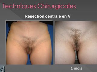 Nymphoplastie ou Labiaplastie: réduction des petites lèvres- labia minora_reduction