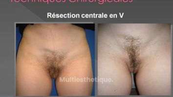 Nymphoplastie ou Labiaplastie: réduction des petites lèvres- labia minora_reduction