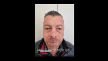 Blépharoplastie - Dr Mohamed Derder