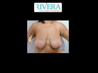 Réduction mammaire - Dr Juan Carlos Rivera