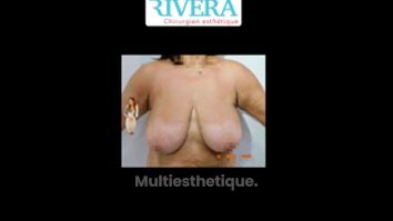 Réduction mammaire - Dr Juan Carlos Rivera