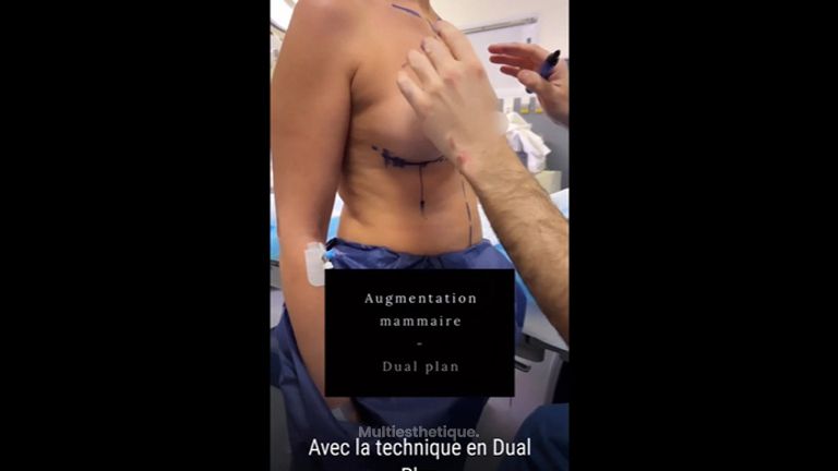 Augmentation mammaire - Dr Maxime Cowen