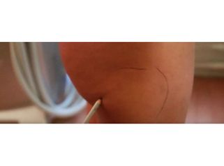 Cryolipolyse