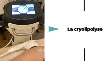 Gommer les rondeurs avec le cryolipolyse - Dr Catherine De Goursac