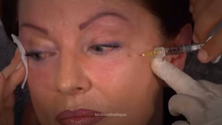 Live injection of the Circle and tear drop with hyaluronic acid