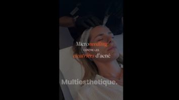 Microneedling - Maison Yokō