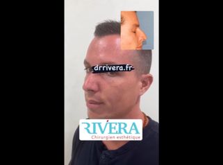 Rhinoplastie - Dr Juan Carlos Rivera