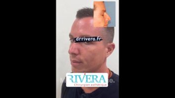 Rhinoplastie - Dr Juan Carlos Rivera